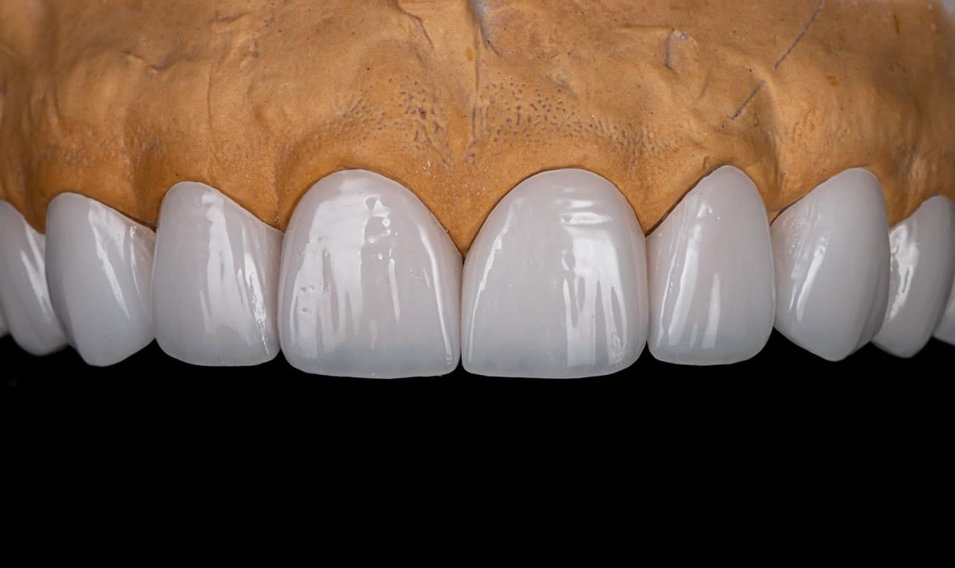 carillas-ceramica-sobre-moldes-dentales