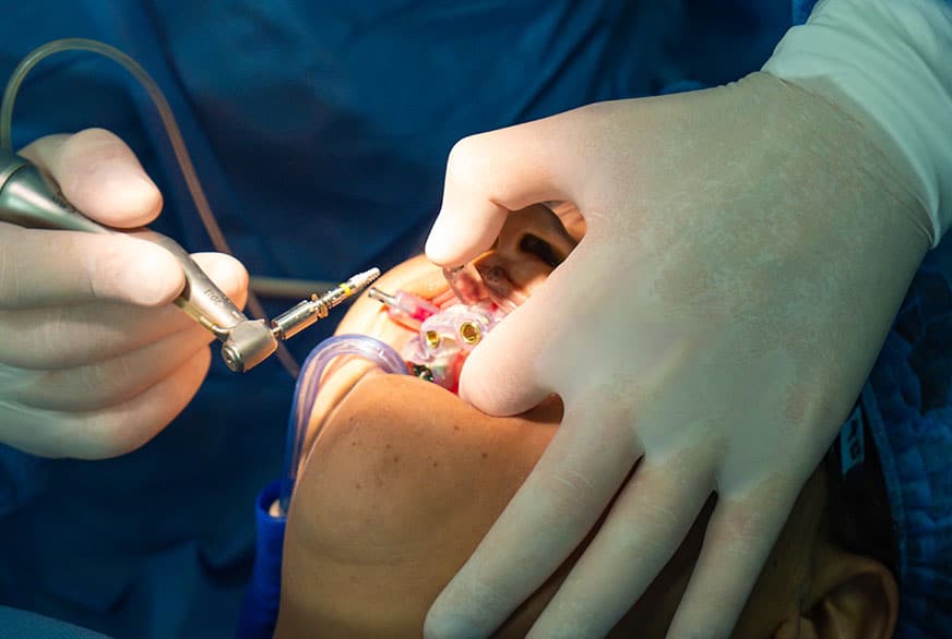 Implantes dentales puestos en la boca de un paciente