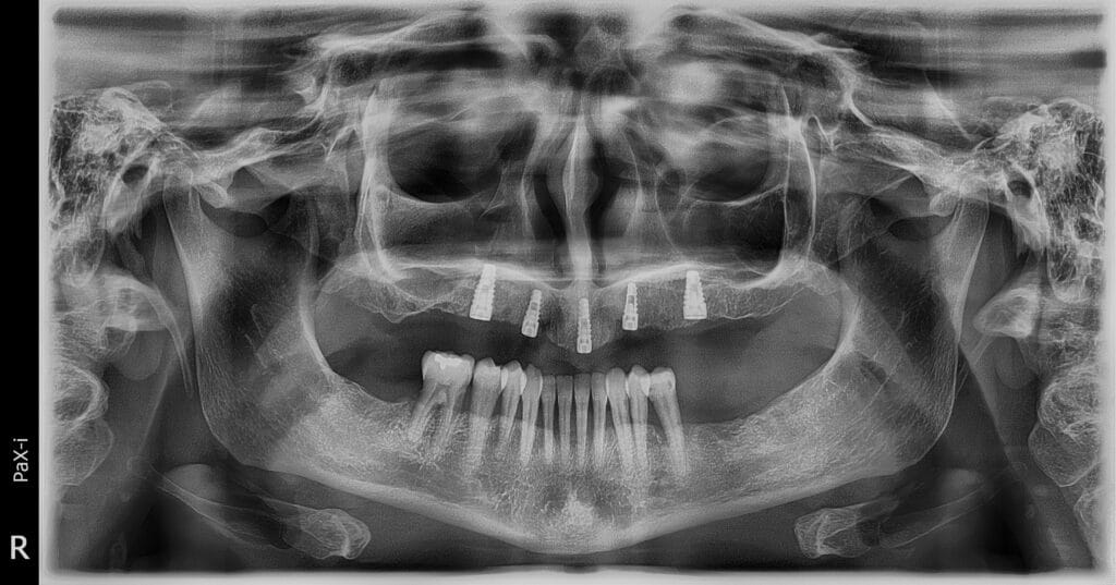 Radiografía panorámica después de posicionar varios implantes con guía quirúrgica