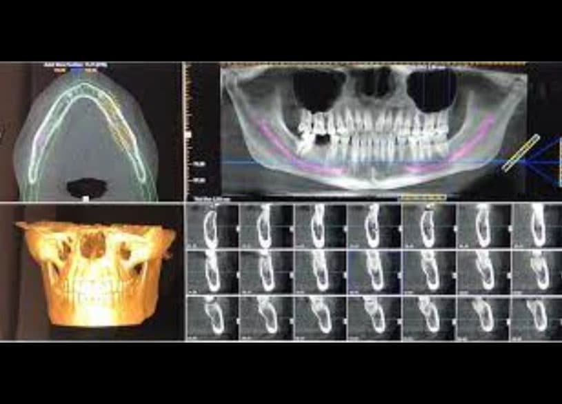 Radiografía maxilar de un paciente previa a procedimiento de implantes dentales