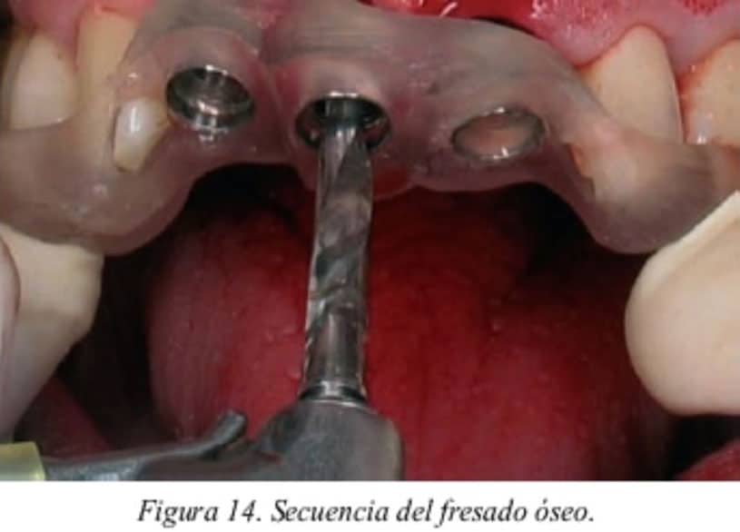 Implantes dentales colocados en la boca de un paciente