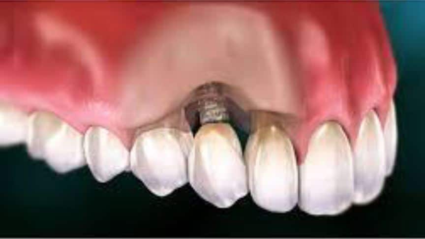 dientes-mostrando-el-perfil-derecho-de-un-implante-dental