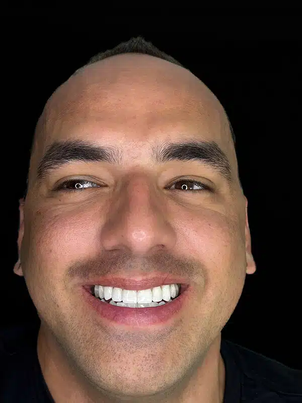 Después 